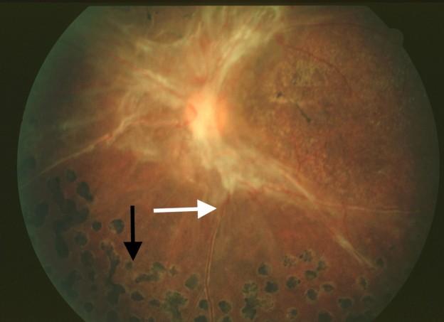 Traction Retinal Detachment A - Endotext